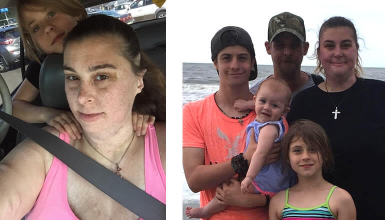 Photos of a woman after reconstruction of burned face and body with her granddaughter in the car and with her family on the beach