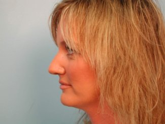 Nose Re-Shaping Surgery, Rhinoplasty and Septoplasty