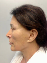 Minimally Invasive Facelift