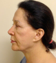 Minimally Invasive Facelift