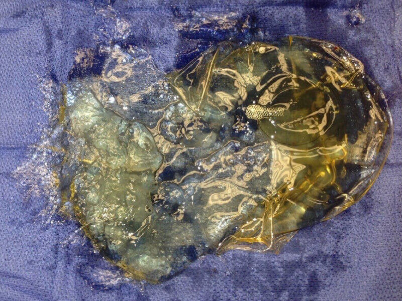 Ruptured Silicone Gel Breast Implant