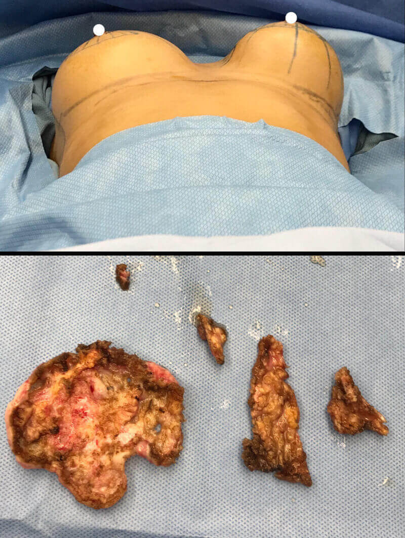severe capsular conracture that caused breast asymmetry