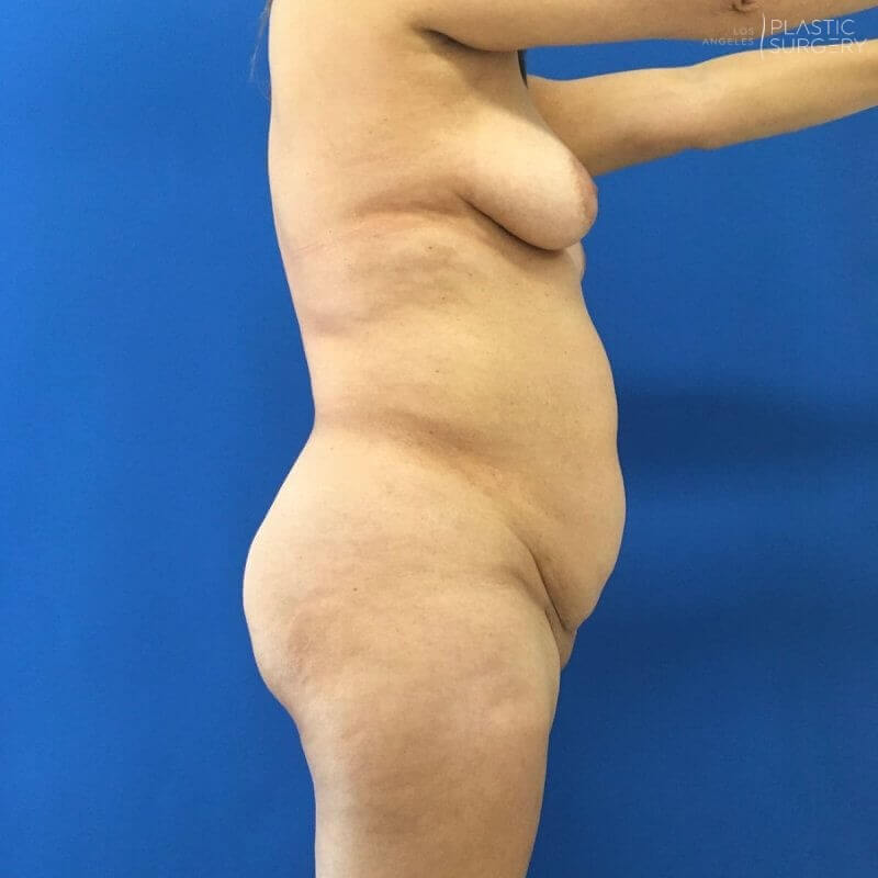 🔥Lipo 360🔥 This 34 year old was unhappy with the appearance of