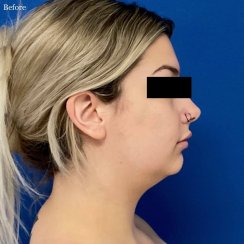 CORRECTION OF DOUBLE CHIN & JAWLINE DEFINITION (24 hours post surgery)