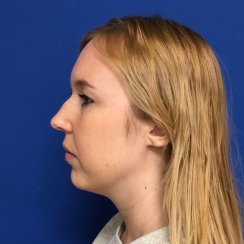 RHINOPLASTY & SEPTOPLASTY