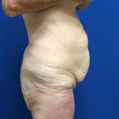 EXTENDED ABDOMINOPLASTY & LOWER BODY LIFT