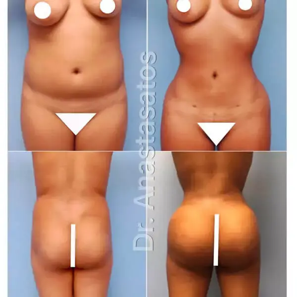 Photos of a young woman's body before and after liposuction
