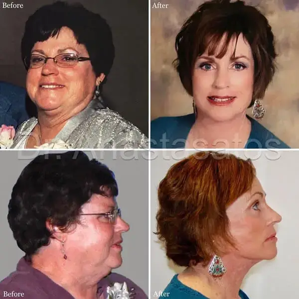 Photos of a mature woman before and after facelift