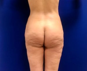 Outer thigh lift