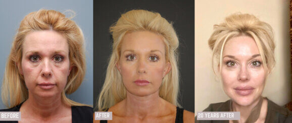 Facelift, Neck Lift & Endoscopic Brow Lift