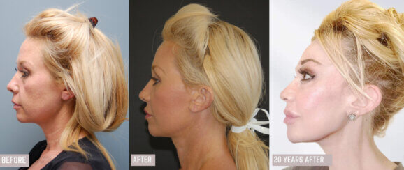 Facelift, Neck Lift & Endoscopic Brow Lift