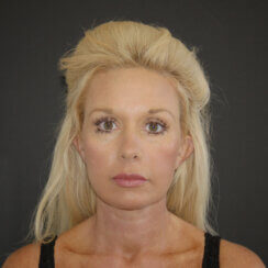 Facelift, Neck Lift & Endoscopic Brow Lift