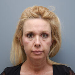 Facelift, Neck Lift & Endoscopic Brow Lift