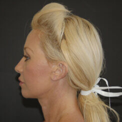 Facelift, Neck Lift & Endoscopic Brow Lift