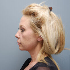 Facelift, Neck Lift & Endoscopic Brow Lift
