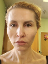 Beautiful 39-year-old lady with minor midface ptosis and minor skin laxity.