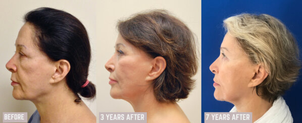 Multiple facelifting and rejuvenation procedures