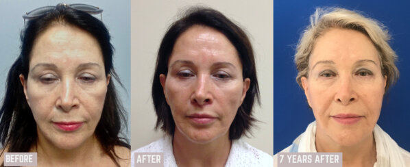 Multiple facelifting and rejuvenation procedures