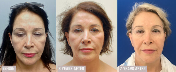 Multiple facelifting and rejuvenation procedures