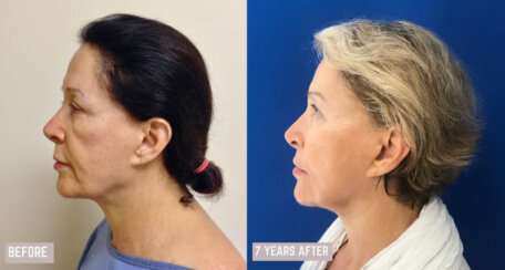 Multiple facelifting and rejuvenation procedures