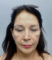 Multiple facelifting and rejuvenation procedures