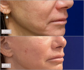 Revision facelift – Secondary facelift