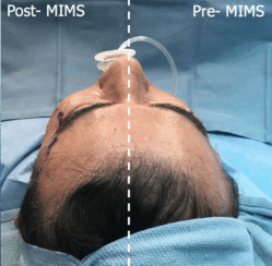 49-year-old male with moderate midface ptosis with skin laxity of the face.