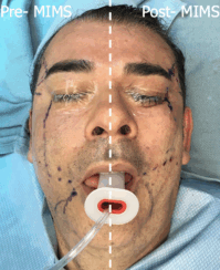49-year-old male with moderate midface ptosis with skin laxity of the face.