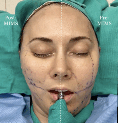 fat transfer to the following areas: under eyes, lips, chin and jawline.