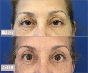 FaceLift and Upper Eyelid Surgery