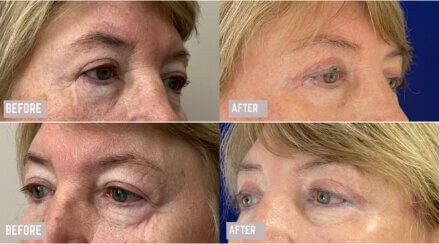 Facial Rejuvenation procedures.
