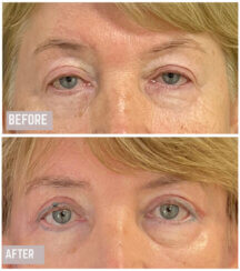 Facial Rejuvenation procedures.