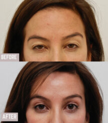 Endoscopic browlift