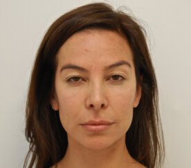 Endoscopic browlift
