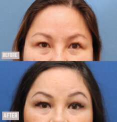 Endoscopic Brow Lift and Facelift