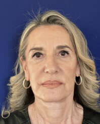 Face and Neck lifting procedures