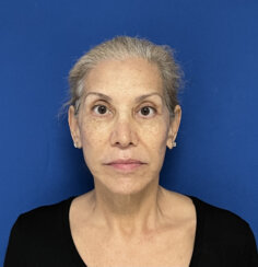 FaceLift and Upper Eyelid Surgery