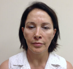 Multiple facelifting and rejuvenation procedures