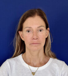 Revision facelift – Secondary facelift