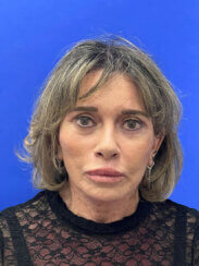 Revision facelift – Secondary facelift and associated face lifting procedures.