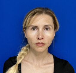 Beautiful 39-year-old lady with minor midface ptosis and minor skin laxity.