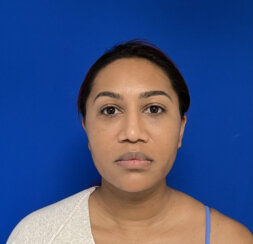 Minimally invasive midface suspension (MIMS)
