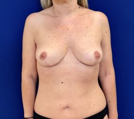 Bilateral breast mastopexy (breast lift) and bilateral breast reduction.