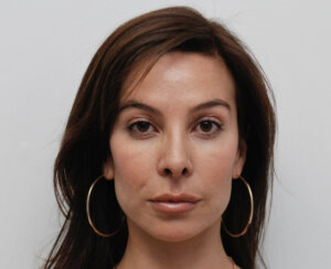 Endoscopic browlift