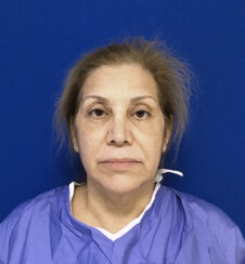 FaceLift and Upper Eyelid Surgery