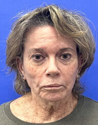 Revision facelift – Secondary facelift and associated face lifting procedures.