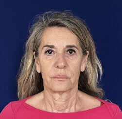 Face and Neck lifting procedures