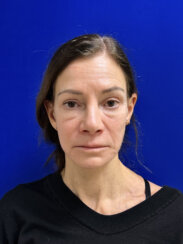 Revision facelift – Secondary facelift