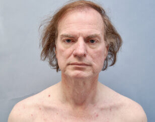 This gentleman had the following facelifting face lifting and neck lifting procedures