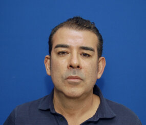 49-year-old male with moderate midface ptosis with skin laxity of the face.